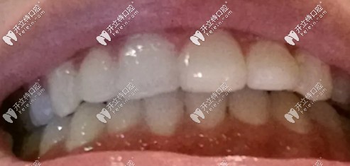 摘到牙套戴保持器，有點深覆合的人很漂亮哦