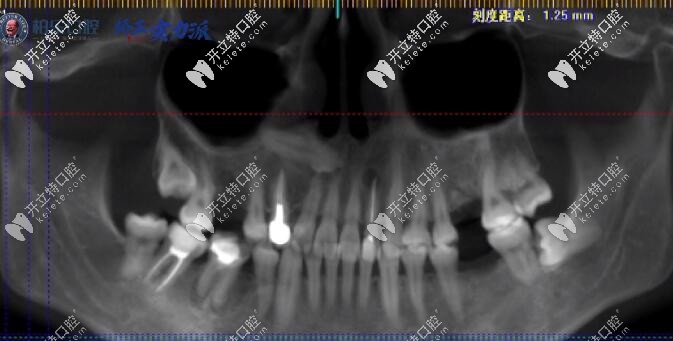 看30歲缺三顆大牙的矯正案例,原來缺牙不是只能做種植牙哦