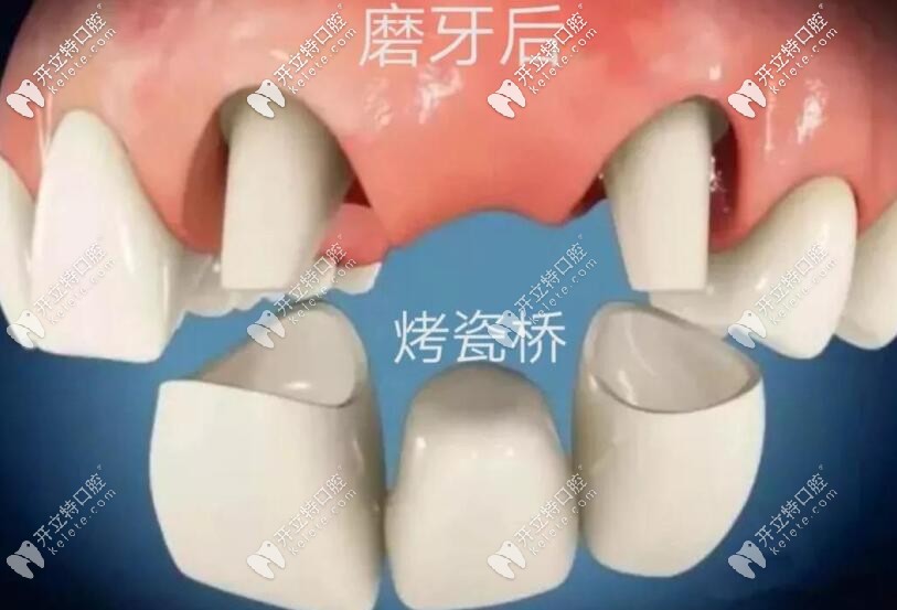 缺牙修復(fù)烤瓷橋 缺牙修復(fù)烤瓷橋