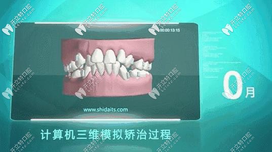 數(shù)字化隱形矯正的矯治過(guò)程