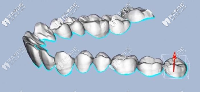 牙齒矯正的模擬圖