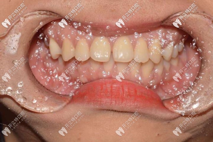 甭問(wèn)我在廈門(mén)思明區(qū)做齙牙矯正花了多少錢(qián),只評(píng)價(jià)效果就OK