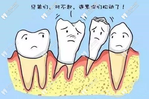 牙周病導(dǎo)致牙齒松動(dòng)