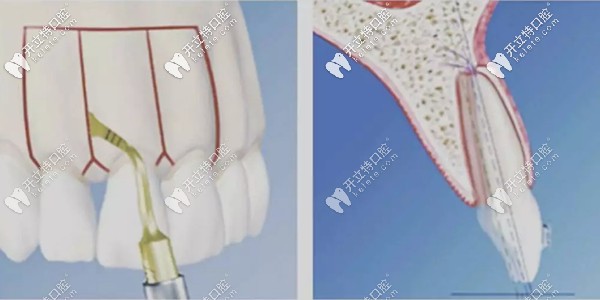 牙周植骨手術(shù)要多少錢(qián)是因人而異,但真沒(méi)網(wǎng)傳幾十萬(wàn)那么貴!