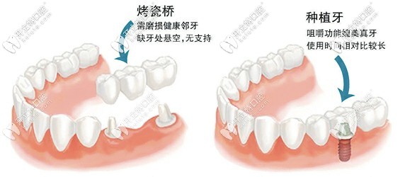 烤瓷牙和種植牙區(qū)別