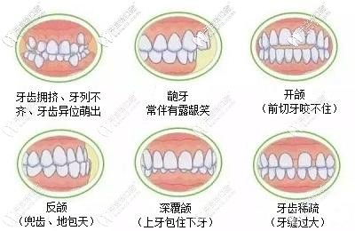鋼牙套針對病例更廣
