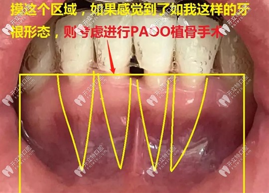 牙周植骨手術(shù)的費(fèi)用要多少錢(qián)呢