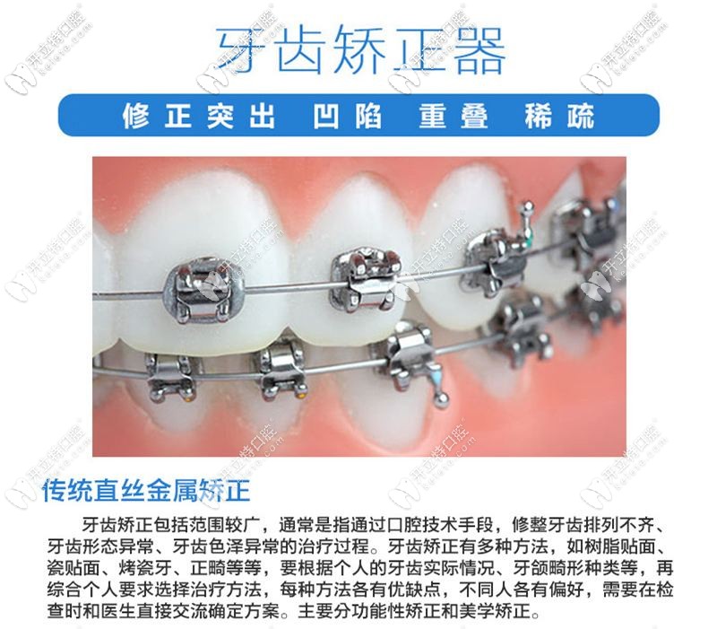 傳統(tǒng)牙齒矯正