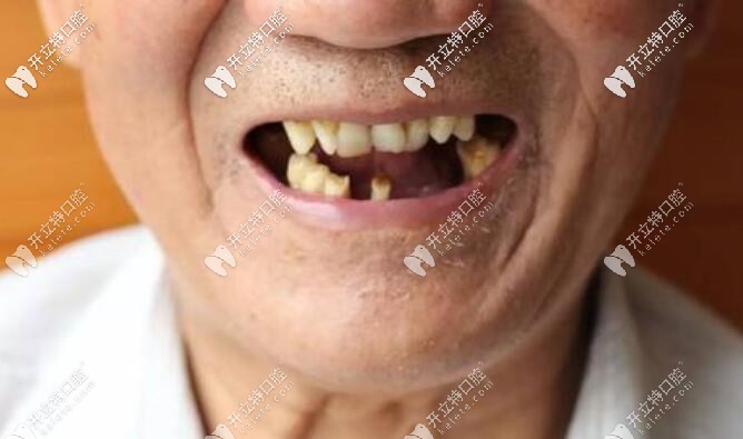 孫玉楓說70、80歲老人種牙好還是鑲牙好