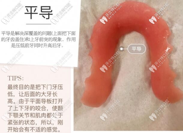 牙齒矯正平導的作用