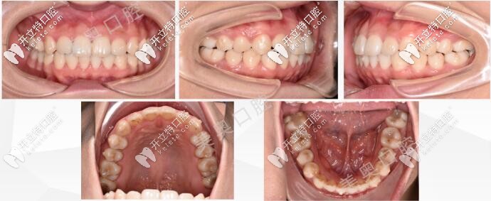 無錫美奧口腔牙齒矯正后的圖片 無錫美奧口腔牙齒矯正后的圖片