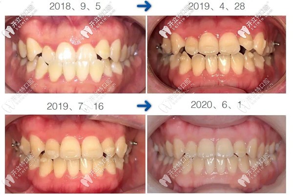 地包天在深圳韋博口腔做矯正前后對(duì)比照片