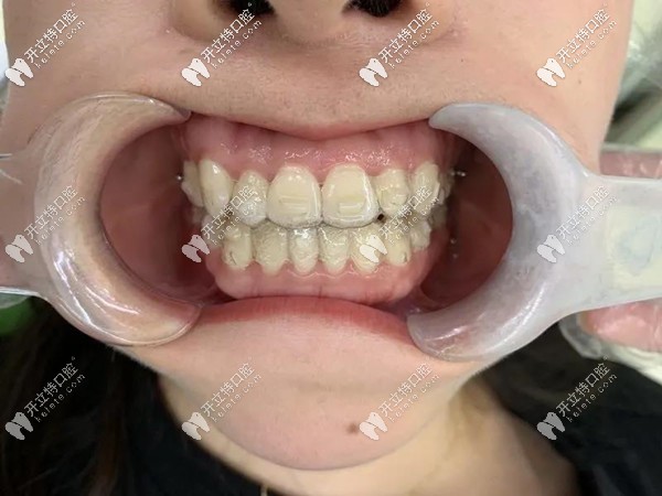 戴時(shí)代天使隱形牙套做牙齒矯正到一半懷孕了