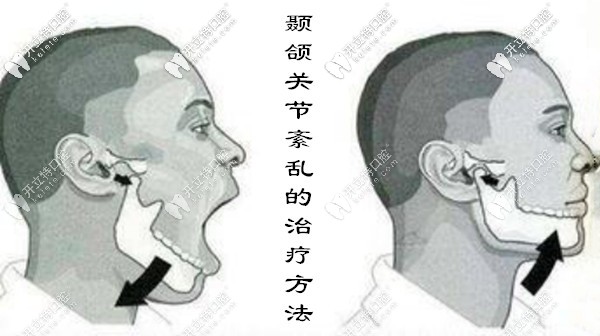 顳下頜關(guān)節(jié)紊亂的治療方法