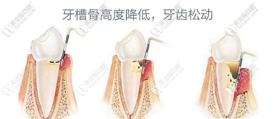 牙周炎會(huì)導(dǎo)致牙齒松動(dòng) 牙周炎會(huì)導(dǎo)致牙齒松動(dòng)