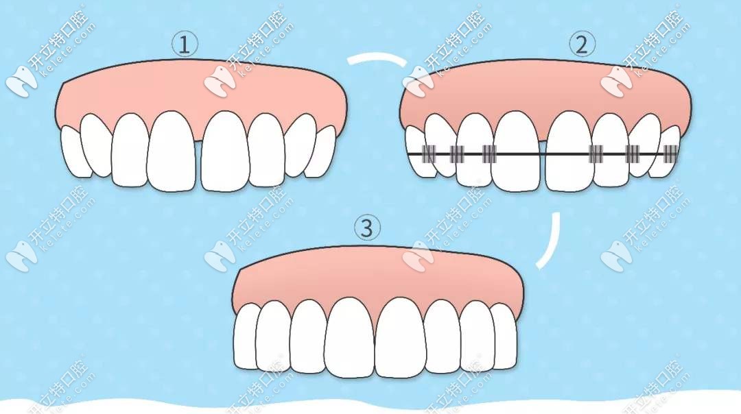 傳統(tǒng)的鋼絲矯正活動(dòng)