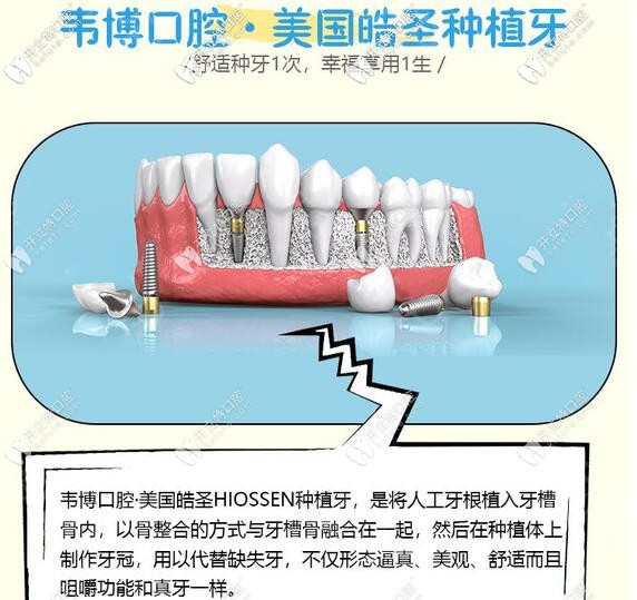 下沙韋博口腔美國皓圣種植牙價(jià)格