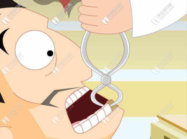 拔牙的價格取決于牙齒復(fù)雜程度