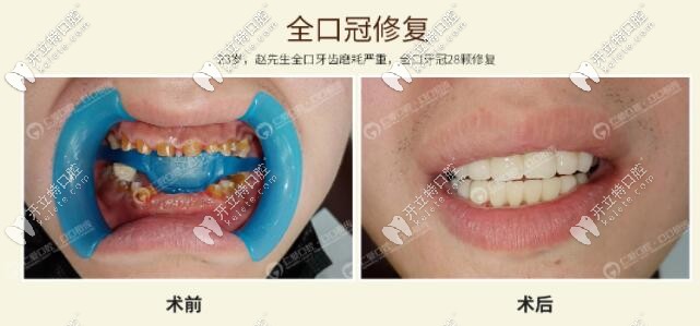 <!--<i data=20240703-sp></i>-->口腔牙齒磨耗全冠修復(fù)真人<span style= <!--<i data=20240703-sp></i>-->口腔牙齒磨耗全冠修復(fù)真人<span style=