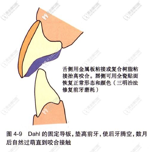 牙齒磨耗的治療方式之正畸 牙齒磨耗的治療方式之正畸