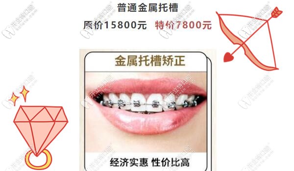 廣州圣貝傳統(tǒng)金屬托槽矯正才7800元啦,暑假正畸不造起來嗎？