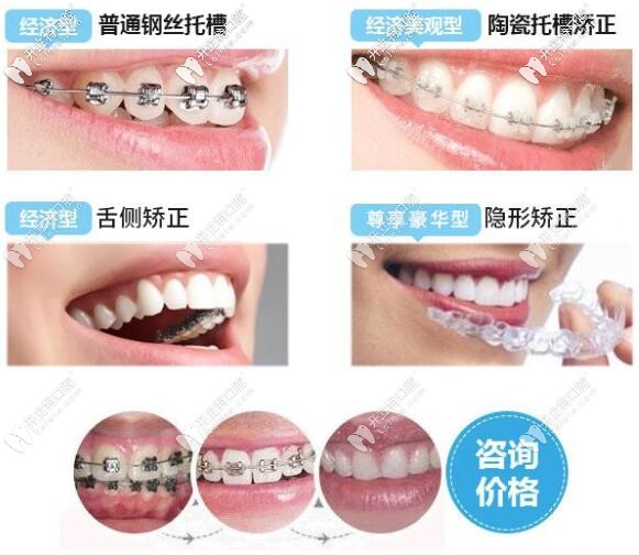 牙套的種類有哪些