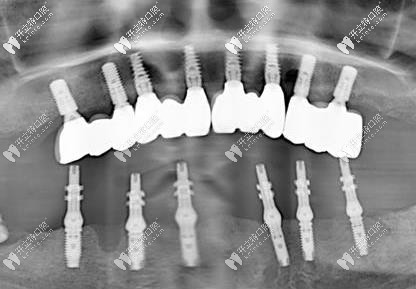 這是種完牙后的照片