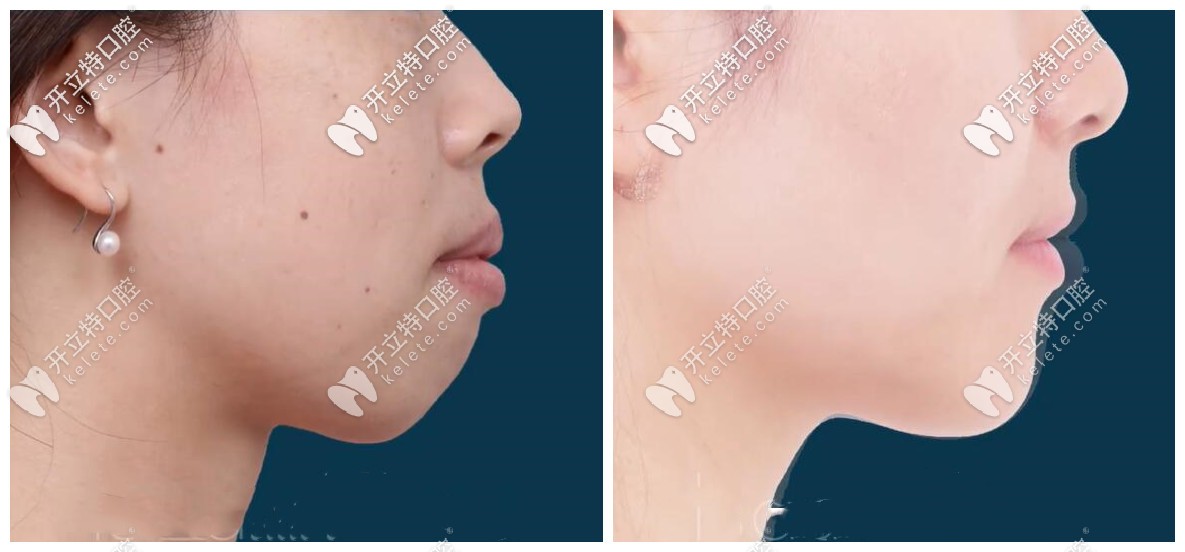 年齡28+的突嘴齙牙小姐姐表示，矯正不亞于整容