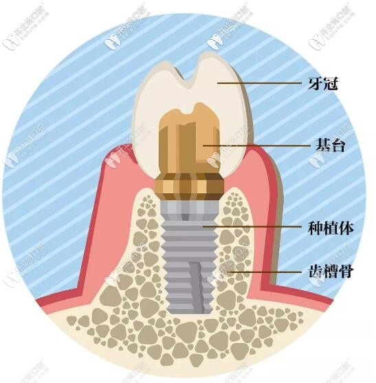 即刻種植牙當(dāng)天種當(dāng)天用是真的嗎?先搞懂和即刻負(fù)重的區(qū)別
