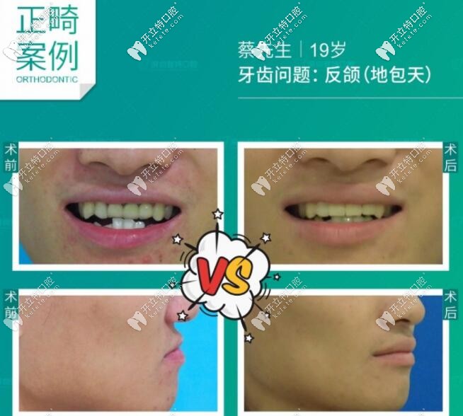 地包天牙齒矯正步驟復雜嗎?剛做完反頜矯正的小哥哥要發(fā)言