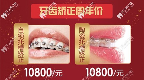 陶瓷托槽和金屬自鎖托槽價格