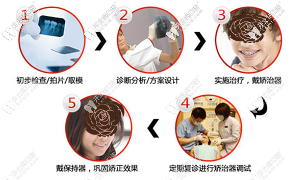 地包天牙齒矯正的步驟流程 地包天牙齒矯正的步驟流程