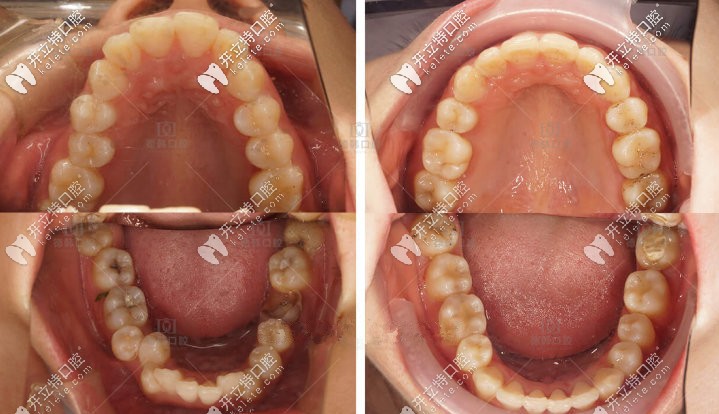 歐巴的口內(nèi)照，牙齒齊了很多撒