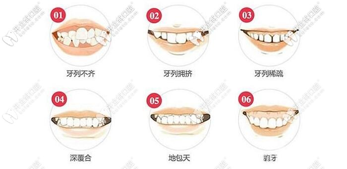牙齒擁擠可能出現(xiàn)的情況