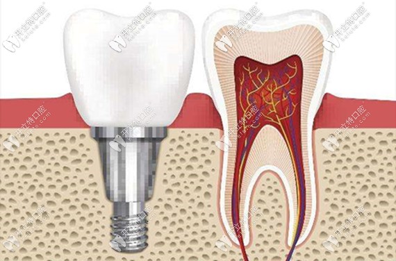 種植牙的費(fèi)用主要包含種植體、牙冠這兩大塊