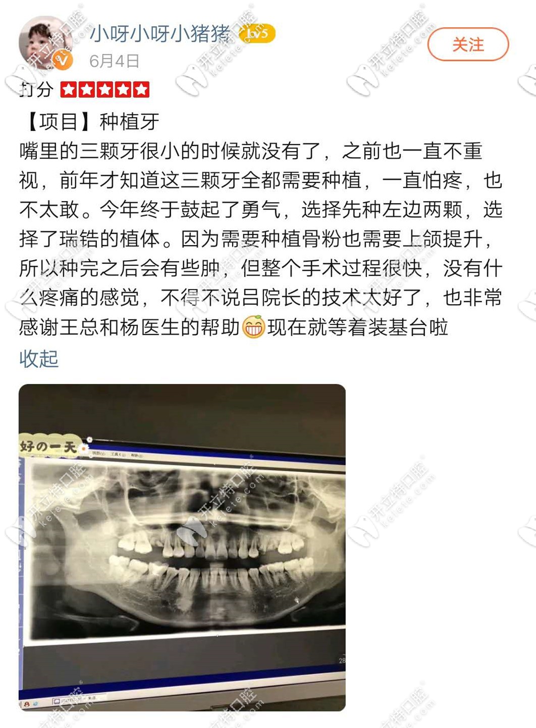 <!--<i data=20240703-sp></i>-->種植牙真心不錯(cuò)