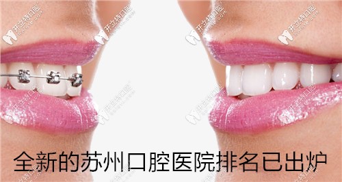 蘇州口腔醫(yī)院排名已發(fā)布！快來看蘇州哪家牙科便宜又好