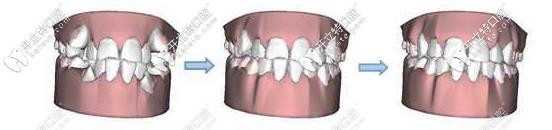 隱形矯正過程牙齒對比圖