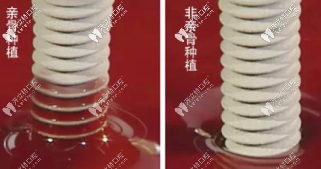 親骨種植和非親骨種植技術(shù)對(duì)比