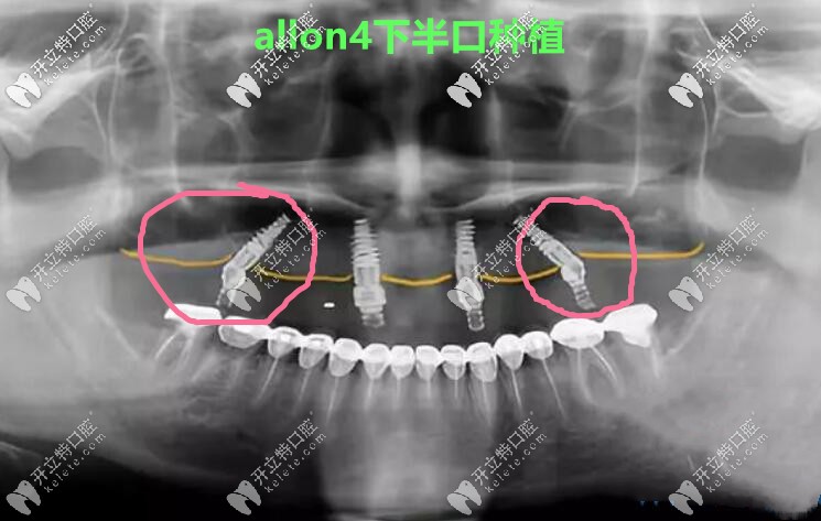 做allon4下半口種植牙真人案例CT照