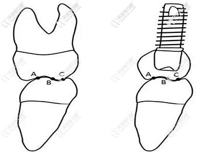 活性親骨種植擁有更強(qiáng)的支撐力