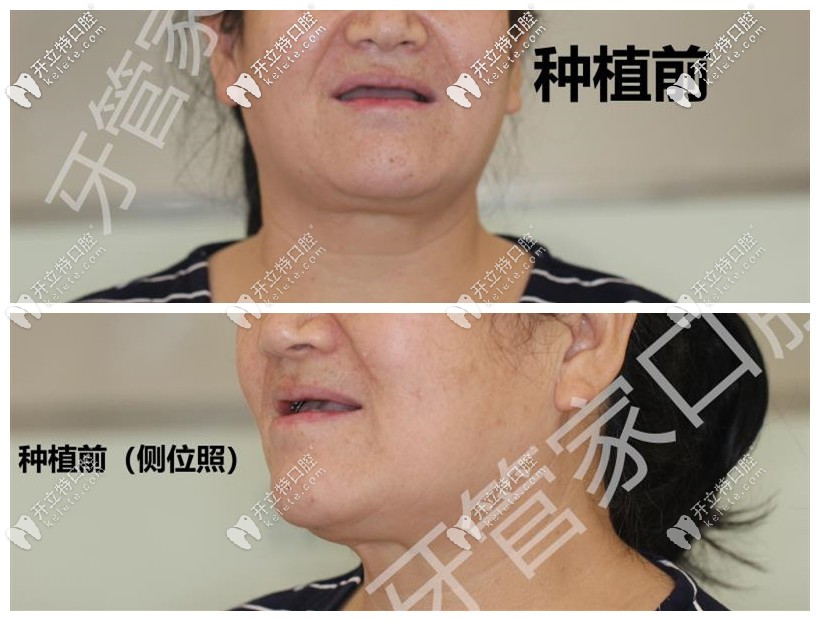 上半口牙缺失面容顯老