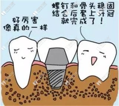 種植牙骨結(jié)合后