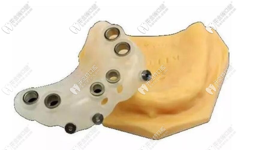 種植牙時(shí)用的導(dǎo)板