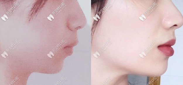 請看凸嘴戴鋼牙套的側(cè)臉變化圖,整牙真的可以實現(xiàn)大逆轉(zhuǎn)