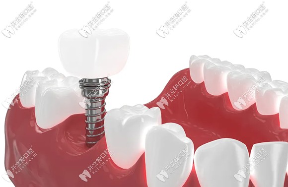 用數據解答:種植的牙齒與自己的真牙一樣耐用嗎?