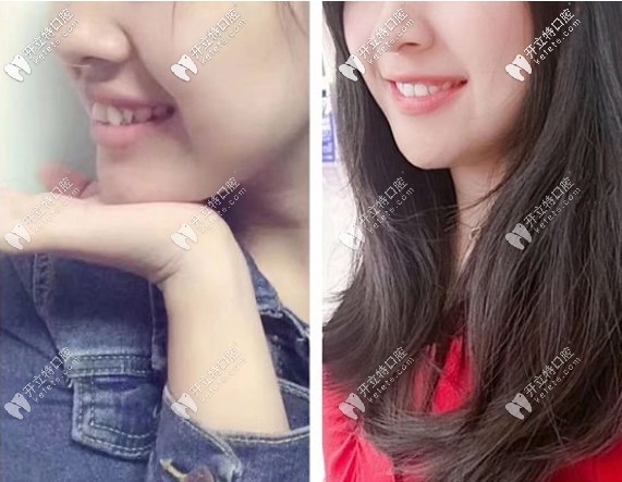銘德口腔矯正牙齒前后對比圖
