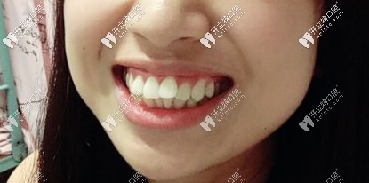 骨性+牙性齙牙，咬合有問題