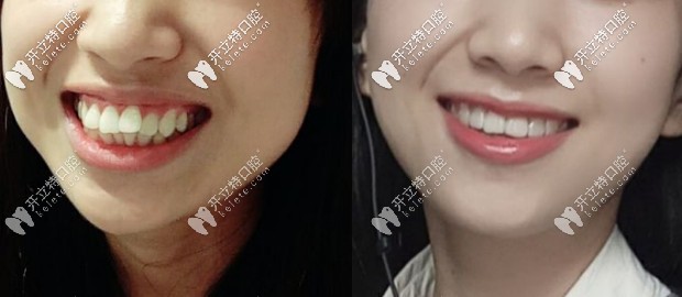齙牙矯正前后效果圖