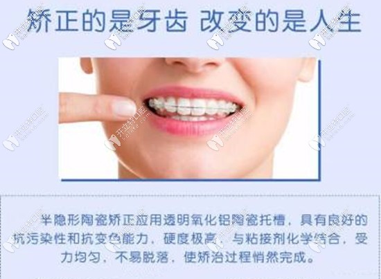 半隱形矯正的優(yōu)勢(shì)